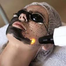 Laser Carbon Facial Training