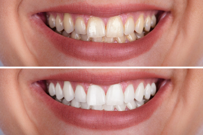 Crystal White Teeth Whitening